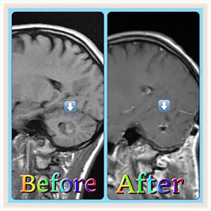 From left to right, side by side black and white brain scans reveal the before and after post-operative results of Brook Lindsay's tumor and tumor removal.