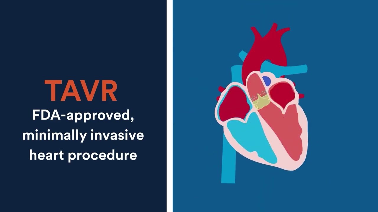 TAVR: FDA-approved, minimally invasive heart procedure
