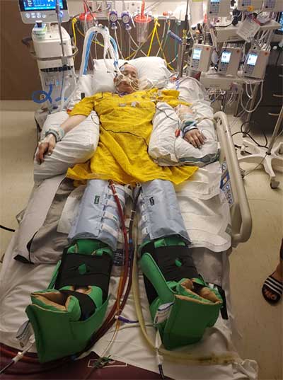 ECMO patient, Katie, lies in a hospital bed in a medical coma and intubated.