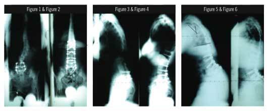 Trudy Smith and Lynda Cavanaugh's spine x-rays, before and after surgery.