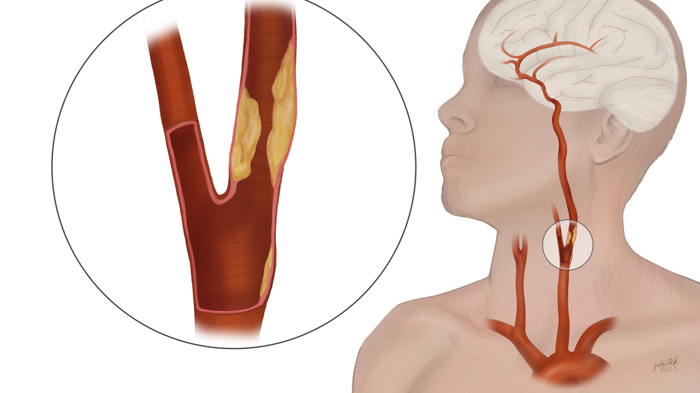 Carotid artery disease is a build-up of plaque in one or both of the neck's main arteries, causing them to narrow and slow down blood flow, potentially causing a stroke if blood flow stops or plaque fragments travel to the brain.