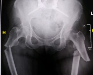 X-ray of Lynette Loughton's hip injury.