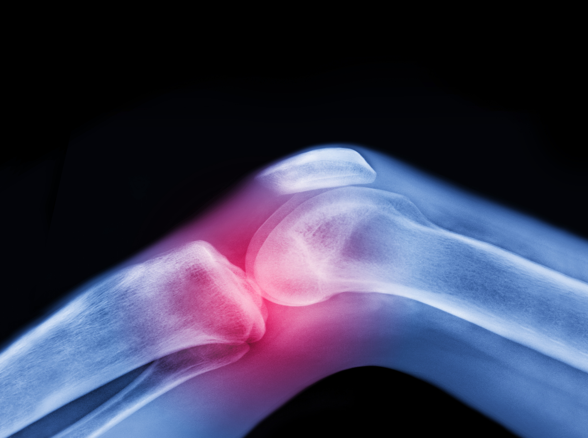 X-ray of the knee with red highlighting a joint problem