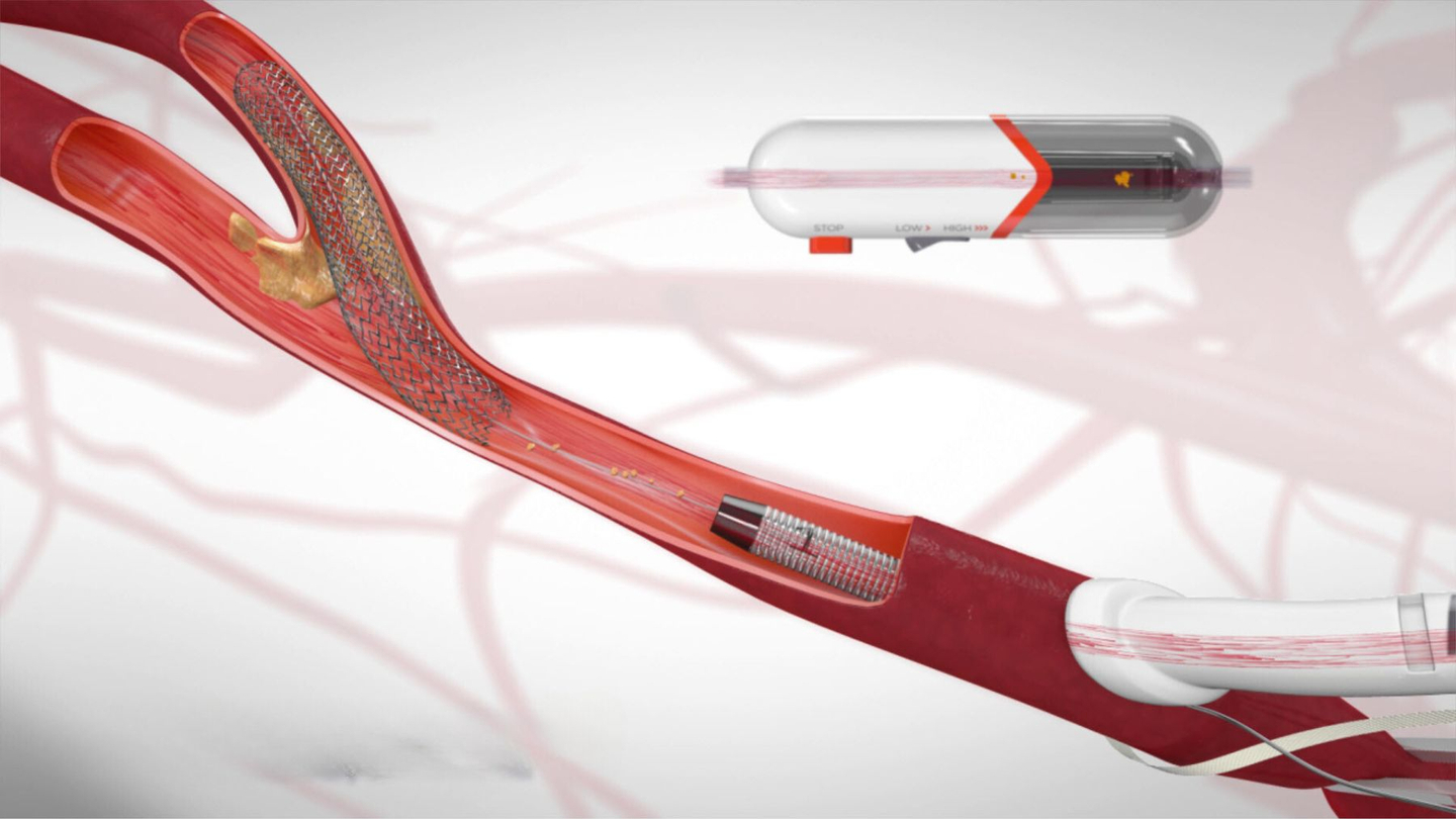 The TCAR procedure temporarily reverses the blood flow so that any small bits of plaque that may break off during the procedure are diverted away from the brain, preventing a stroke from happening. A stent is then placed inside the artery to stabilize the plaque, minimizing the risk of a future stroke.