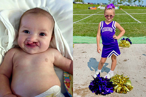 Combined picture of Audrey Sue when she was a baby, prior to having cleft palate surgery, and then again as a child, wearing a cheerleading uniform at a sporting event.